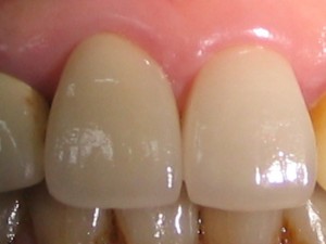 甲3　ラミネートべニア　と　オールセラミッククラウン（前面）　